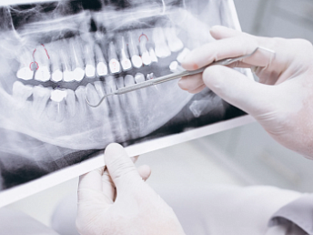 Новое зубное покрытие поможет в борьбе с кариесом и восстановить эмаль