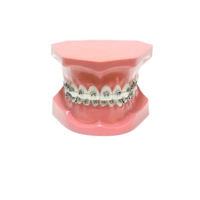ORB01 – ортодонтическая модель с брекетами и твердой десной, 1 класс | GF Dental (Италия)