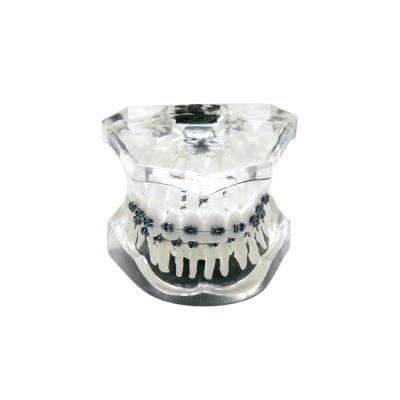 OTB3 – прозрачная ортодонтическая модель с брекетами и твердой десной, 2 класс | GF Dental (Италия)