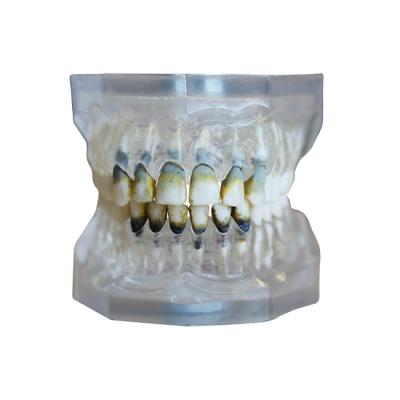 ЧВН-28П - денто-модель верхней и нижней челюстей для практики лечения пародонтоза | Зарница (Россия)