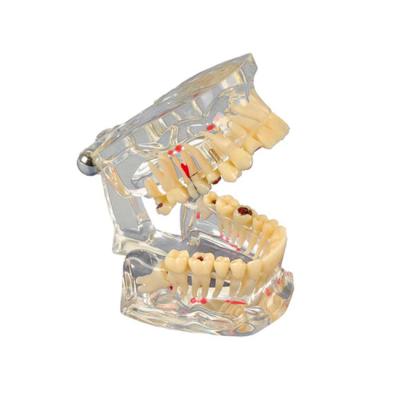 Study Model Transparent De Luxe - высококачественная прозрачная демонстрационная модель с различными клиническими случаями | Hager & Werken (Германия)