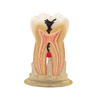 TOOTH MODEL H-TYPE - модель зуба c сагиттальным разрезом | Hanil (Ю. Корея)